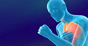 Bronchiectasis